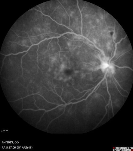 Syphilitic optic neuritis
Two weeks ago she woke up with blurred vision in the left eye.  She usually gets up at 5 AM.  Then she noticed a gray spot in the left eye that did not go away.  This is new for her.  The gray spot is not getting any better or worse in the left eye. (4/4/23)
Systemic Meds: Lisinopril 40 mg. metformin hydrochloride 1000 MG. nifedipine 30mg 
VA OD: sc20/80 PH20/50 NscJ10
VA OS: sc2'/200 Nsc20/400
IOP: TP: OD:15 OS:16 
No AC or vitreous cells - later images was with second eye involved with uveitis.  Patient received IV PCN and was lost to follow-up
