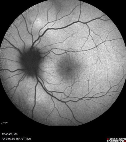 Syphilitic optic neuritis
Two weeks ago she woke up with blurred vision in the left eye.  She usually gets up at 5 AM.  Then she noticed a gray spot in the left eye that did not go away.  This is new for her.  The gray spot is not getting any better or worse in the left eye. (4/4/23)
Systemic Meds: Lisinopril 40 mg. metformin hydrochloride 1000 MG. nifedipine 30mg 
VA OD: sc20/80 PH20/50 NscJ10
VA OS: sc2'/200 Nsc20/400
IOP: TP: OD:15 OS:16 
No AC or vitreous cells - later images was with second eye involved with uveitis.  Patient received IV PCN and was lost to follow-up
