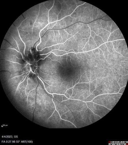 Syphilitic optic neuritis
Two weeks ago she woke up with blurred vision in the left eye.  She usually gets up at 5 AM.  Then she noticed a gray spot in the left eye that did not go away.  This is new for her.  The gray spot is not getting any better or worse in the left eye. (4/4/23)
Systemic Meds: Lisinopril 40 mg. metformin hydrochloride 1000 MG. nifedipine 30mg 
VA OD: sc20/80 PH20/50 NscJ10
VA OS: sc2'/200 Nsc20/400
IOP: TP: OD:15 OS:16 
No AC or vitreous cells - later images was with second eye involved with uveitis.  Patient received IV PCN and was lost to follow-up

