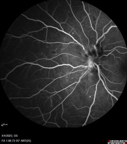 Syphilitic optic neuritis
Two weeks ago she woke up with blurred vision in the left eye.  She usually gets up at 5 AM.  Then she noticed a gray spot in the left eye that did not go away.  This is new for her.  The gray spot is not getting any better or worse in the left eye. (4/4/23)
Systemic Meds: Lisinopril 40 mg. metformin hydrochloride 1000 MG. nifedipine 30mg 
VA OD: sc20/80 PH20/50 NscJ10
VA OS: sc2'/200 Nsc20/400
IOP: TP: OD:15 OS:16 
No AC or vitreous cells - later images was with second eye involved with uveitis.  Patient received IV PCN and was lost to follow-up
