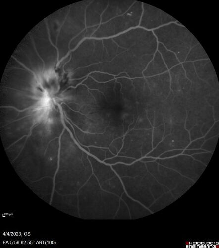 Syphilitic optic neuritis
Two weeks ago she woke up with blurred vision in the left eye.  She usually gets up at 5 AM.  Then she noticed a gray spot in the left eye that did not go away.  This is new for her.  The gray spot is not getting any better or worse in the left eye. (4/4/23)
Systemic Meds: Lisinopril 40 mg. metformin hydrochloride 1000 MG. nifedipine 30mg 
VA OD: sc20/80 PH20/50 NscJ10
VA OS: sc2'/200 Nsc20/400
IOP: TP: OD:15 OS:16 
No AC or vitreous cells - later images was with second eye involved with uveitis.  Patient received IV PCN and was lost to follow-up
