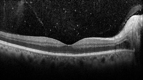Syphilitic optic neuritis
Two weeks ago she woke up with blurred vision in the left eye.  She usually gets up at 5 AM.  Then she noticed a gray spot in the left eye that did not go away.  This is new for her.  The gray spot is not getting any better or worse in the left eye. (4/4/23)
Systemic Meds: Lisinopril 40 mg. metformin hydrochloride 1000 MG. nifedipine 30mg 
VA OD: sc20/80 PH20/50 NscJ10
VA OS: sc2'/200 Nsc20/400
IOP: TP: OD:15 OS:16 
No AC or vitreous cells - later images was with second eye involved with uveitis.  Patient received IV PCN and was lost to follow-up
