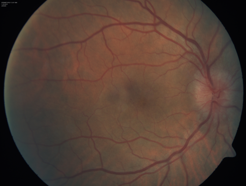 Syphillitic Optic Neuropathy and Maculopathy
46 year old woman with 2 weeks of vision loss OD.  VA 20/200 OD; 20/20 OS.  there are posterior vitreous cells on OCT in both eyes.  ICG, FAF, and FA show an abnormal macula OD.  VA improved to 20/30 within a month with treatment with PCN.
Keywords: syphillis