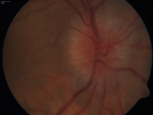 Syphillitic Optic Neuropathy and Maculopathy
46 year old woman with 2 weeks of vision loss OD.  VA 20/200 OD; 20/20 OS.  there are posterior vitreous cells on OCT in both eyes.  ICG, FAF, and FA show an abnormal macula OD.  VA improved to 20/30 within a month with treatment with PCN.
Keywords: syphillis