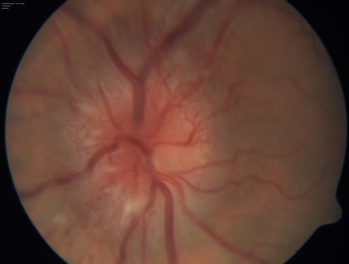 Syphillitic Optic Neuropathy and Maculopathy
46 year old woman with 2 weeks of vision loss OD.  VA 20/200 OD; 20/20 OS.  there are posterior vitreous cells on OCT in both eyes.  ICG, FAF, and FA show an abnormal macula OD.  VA improved to 20/30 within a month with treatment with PCN.
Mots-clés: syphillis