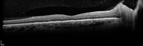 Syphillitic Optic Neuropathy and Maculopathy
46 year old woman with 2 weeks of vision loss OD.  VA 20/200 OD; 20/20 OS.  there are posterior vitreous cells on OCT in both eyes.  ICG, FAF, and FA show an abnormal macula OD.  VA improved to 20/30 within a month with treatment with PCN.
Keywords: syphillis