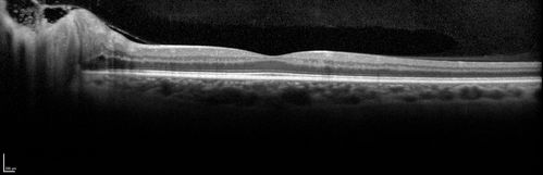 Syphillitic Optic Neuropathy and Maculopathy
46 year old woman with 2 weeks of vision loss OD.  VA 20/200 OD; 20/20 OS.  there are posterior vitreous cells on OCT in both eyes.  ICG, FAF, and FA show an abnormal macula OD.  VA improved to 20/30 within a month with treatment with PCN.
Keywords: syphillis