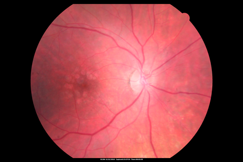 Syphilitic Chorioretinitis
Severe outer retinal atrophy and RPE non-geographic atrophy from syphilis.  Vision improved from 20/63 to 20/32 with therapy.  Images look a lot like DUSN.  Patient had several surgeries (vitrectomy for floaters, vitrectomy for macular pucker, Avastin injections and macular laser for edema) prior by other retina specialists prior to being correctly diagnosed and treated.
