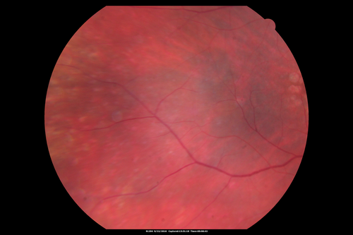 Syphilitic Chorioretinitis
Severe outer retinal atrophy and RPE non-geographic atrophy from syphilis.  Vision improved from 20/63 to 20/32 with therapy.  Images look a lot like DUSN.  Patient had several surgeries (vitrectomy for floaters, vitrectomy for macular pucker, Avastin injections and macular laser for edema) prior by other retina specialists prior to being correctly diagnosed and treated.
