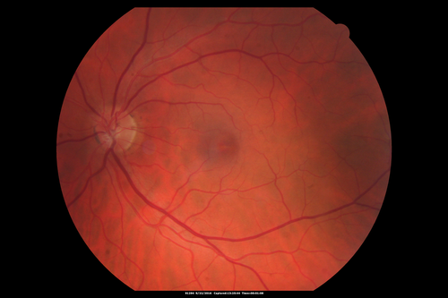 Syphilitic Chorioretinitis
Severe outer retinal atrophy and RPE non-geographic atrophy from syphilis.  Vision improved from 20/63 to 20/32 with therapy.  Images look a lot like DUSN.  Patient had several surgeries (vitrectomy for floaters, vitrectomy for macular pucker, Avastin injections and macular laser for edema) prior by other retina specialists prior to being correctly diagnosed and treated.

