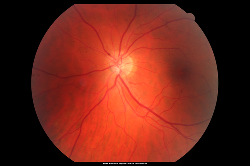 Syphilitic Chorioretinitis
Severe outer retinal atrophy and RPE non-geographic atrophy from syphilis.  Vision improved from 20/63 to 20/32 with therapy.  Images look a lot like DUSN.  Patient had several surgeries (vitrectomy for floaters, vitrectomy for macular pucker, Avastin injections and macular laser for edema) prior by other retina specialists prior to being correctly diagnosed and treated.
