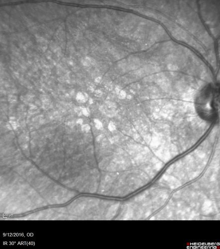 Syphilitic Chorioretinitis
Severe outer retinal atrophy and RPE non-geographic atrophy from syphilis.  Vision improved from 20/63 to 20/32 with therapy.  Images look a lot like DUSN.  Patient had several surgeries (vitrectomy for floaters, vitrectomy for macular pucker, Avastin injections and macular laser for edema) prior by other retina specialists prior to being correctly diagnosed and treated.
