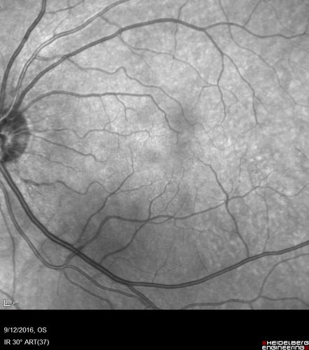 Syphilitic Chorioretinitis
Severe outer retinal atrophy and RPE non-geographic atrophy from syphilis.  Vision improved from 20/63 to 20/32 with therapy.  Images look a lot like DUSN.  Patient had several surgeries (vitrectomy for floaters, vitrectomy for macular pucker, Avastin injections and macular laser for edema) prior by other retina specialists prior to being correctly diagnosed and treated.
