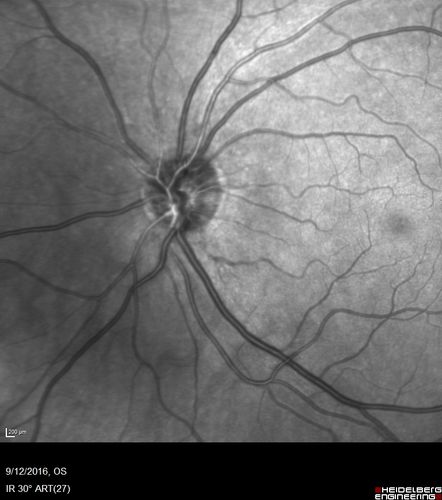Syphilitic Chorioretinitis
Severe outer retinal atrophy and RPE non-geographic atrophy from syphilis.  Vision improved from 20/63 to 20/32 with therapy.  Images look a lot like DUSN.  Patient had several surgeries (vitrectomy for floaters, vitrectomy for macular pucker, Avastin injections and macular laser for edema) prior by other retina specialists prior to being correctly diagnosed and treated.
