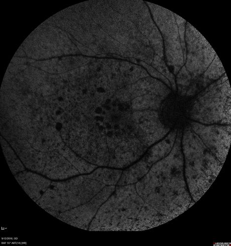 Syphilitic Chorioretinitis
Severe outer retinal atrophy and RPE non-geographic atrophy from syphilis.  Vision improved from 20/63 to 20/32 with therapy.  Images look a lot like DUSN.  Patient had several surgeries (vitrectomy for floaters, vitrectomy for macular pucker, Avastin injections and macular laser for edema) prior by other retina specialists prior to being correctly diagnosed and treated.
