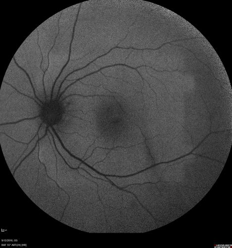 Syphilitic Chorioretinitis
Severe outer retinal atrophy and RPE non-geographic atrophy from syphilis.  Vision improved from 20/63 to 20/32 with therapy.  Images look a lot like DUSN.  Patient had several surgeries (vitrectomy for floaters, vitrectomy for macular pucker, Avastin injections and macular laser for edema) prior by other retina specialists prior to being correctly diagnosed and treated.
