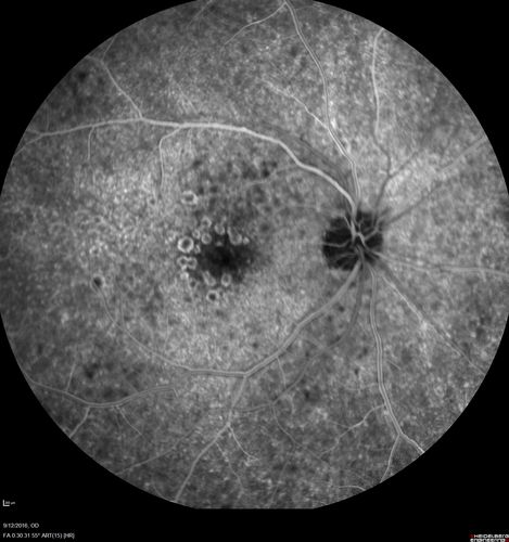 Syphilitic Chorioretinitis
Severe outer retinal atrophy and RPE non-geographic atrophy from syphilis.  Vision improved from 20/63 to 20/32 with therapy.  Images look a lot like DUSN.  Patient had several surgeries (vitrectomy for floaters, vitrectomy for macular pucker, Avastin injections and macular laser for edema) prior by other retina specialists prior to being correctly diagnosed and treated.
