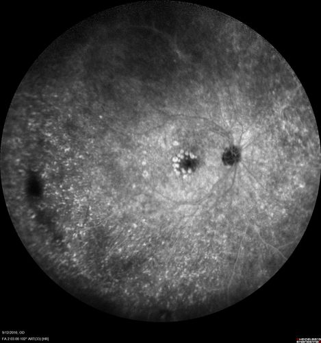 Syphilitic Chorioretinitis
Severe outer retinal atrophy and RPE non-geographic atrophy from syphilis.  Vision improved from 20/63 to 20/32 with therapy.  Images look a lot like DUSN.  Patient had several surgeries (vitrectomy for floaters, vitrectomy for macular pucker, Avastin injections and macular laser for edema) prior by other retina specialists prior to being correctly diagnosed and treated.
