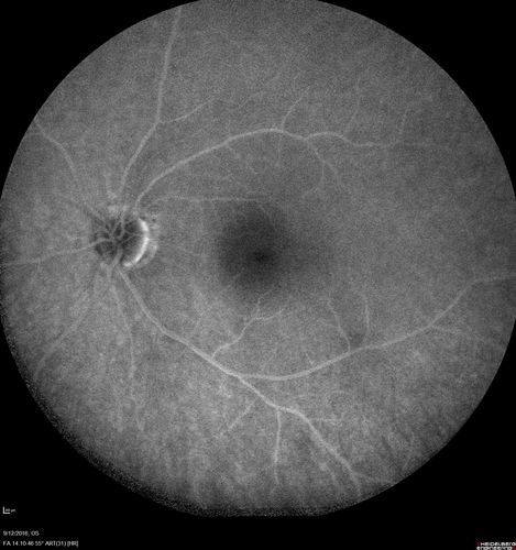 Syphilitic Chorioretinitis
Severe outer retinal atrophy and RPE non-geographic atrophy from syphilis.  Vision improved from 20/63 to 20/32 with therapy.  Images look a lot like DUSN.  Patient had several surgeries (vitrectomy for floaters, vitrectomy for macular pucker, Avastin injections and macular laser for edema) prior by other retina specialists prior to being correctly diagnosed and treated.
