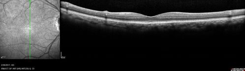 Syphilitic Optic Neuritis - possible Gumma
82 year old woman with vision loss in the left eye 20/32 and positive FTA-ABS (negative RPR). - this may be a gumma
