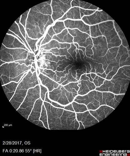 Syphilitic Optic Neuritis - possible Gumma
82 year old woman with vision loss in the left eye 20/32 and positive FTA-ABS (negative RPR). - this may be a gumma
