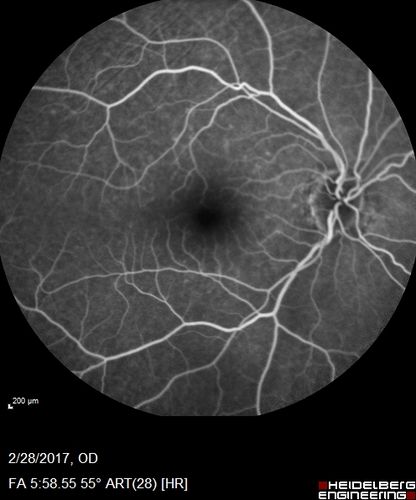Syphilitic Optic Neuritis - possible Gumma
82 year old woman with vision loss in the left eye 20/32 and positive FTA-ABS (negative RPR). - this may be a gumma
