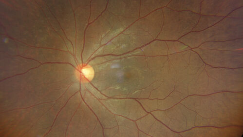 Syphilitic Chorioretinitis
41 year old man with vision loss for five days left eye.  VA 20/32, 20/200
