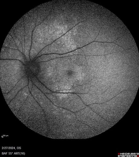 Syphilitic Chorioretinitis
41 year old man with vision loss for five days left eye.  VA 20/32, 20/200

