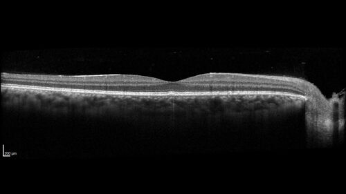 Syphilitic Chorioretinitis
41 year old man with vision loss for five days left eye.  VA 20/32, 20/200
