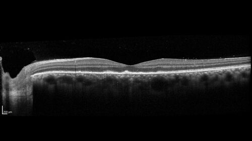 Syphilitic Chorioretinitis
41 year old man with vision loss for five days left eye.  VA 20/32, 20/200
