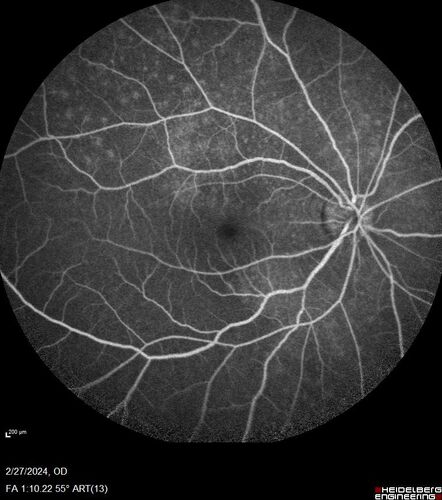 Syphilitic Chorioretinitis
41 year old man with vision loss for five days left eye.  VA 20/32, 20/200

