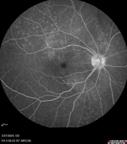Syphilitic Chorioretinitis
41 year old man with vision loss for five days left eye.  VA 20/32, 20/200
