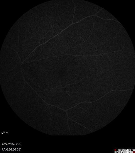 Syphilitic Chorioretinitis
41 year old man with vision loss for five days left eye.  VA 20/32, 20/200
