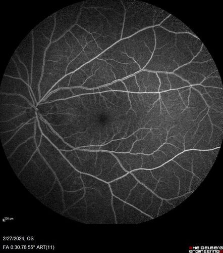 Syphilitic Chorioretinitis
41 year old man with vision loss for five days left eye.  VA 20/32, 20/200
