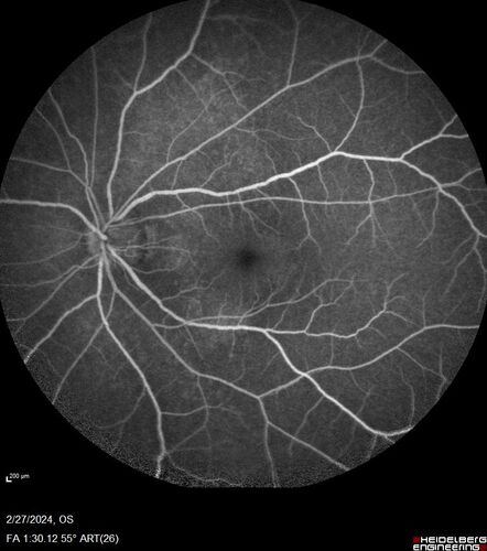 Syphilitic Chorioretinitis
41 year old man with vision loss for five days left eye.  VA 20/32, 20/200
