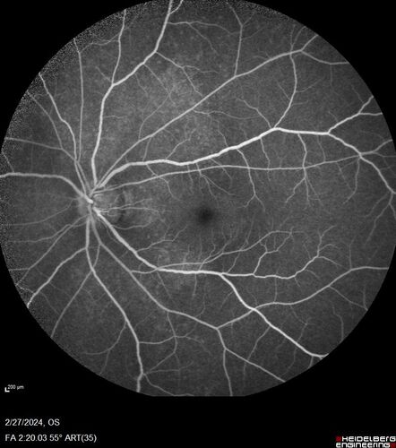 Syphilitic Chorioretinitis
41 year old man with vision loss for five days left eye.  VA 20/32, 20/200
