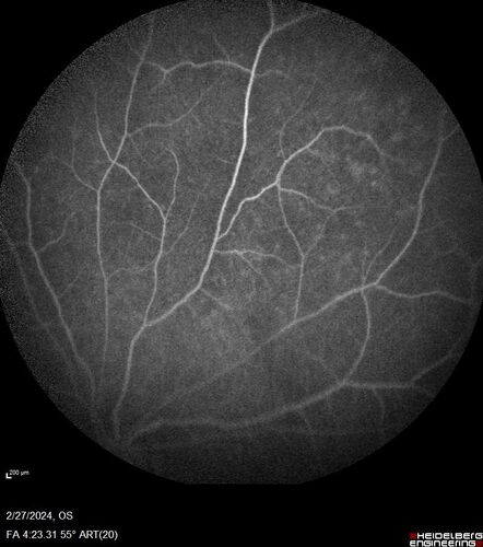 Syphilitic Chorioretinitis
41 year old man with vision loss for five days left eye.  VA 20/32, 20/200
