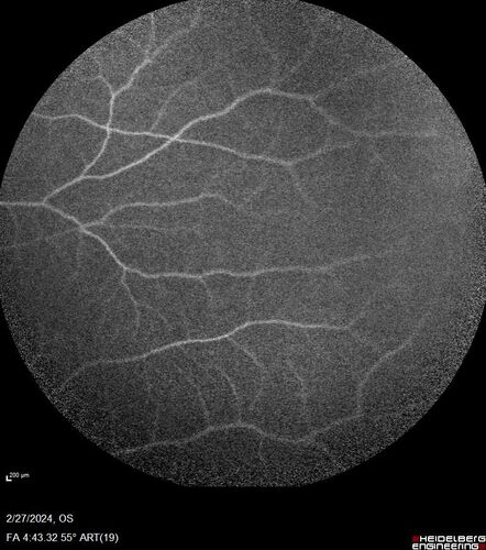Syphilitic Chorioretinitis
41 year old man with vision loss for five days left eye.  VA 20/32, 20/200
