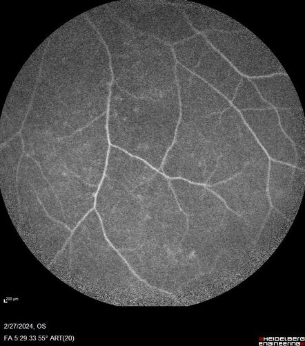 Syphilitic Chorioretinitis
41 year old man with vision loss for five days left eye.  VA 20/32, 20/200

