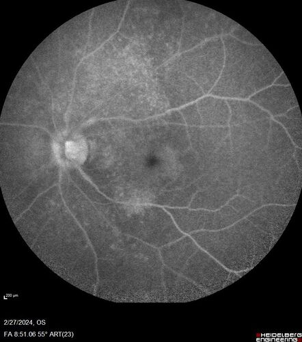 Syphilitic Chorioretinitis
41 year old man with vision loss for five days left eye.  VA 20/32, 20/200
