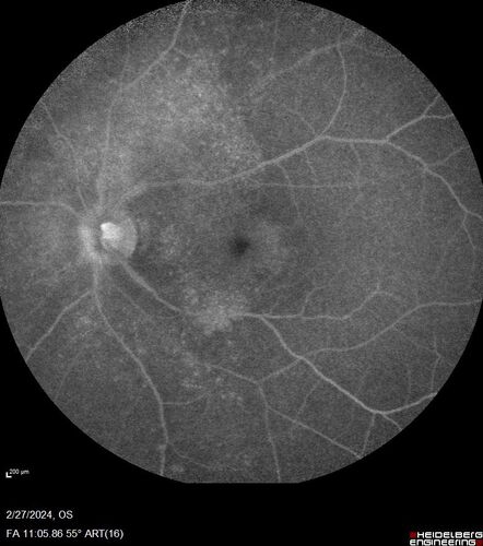 Syphilitic Chorioretinitis
41 year old man with vision loss for five days left eye.  VA 20/32, 20/200
