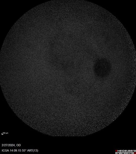 Syphilitic Chorioretinitis
41 year old man with vision loss for five days left eye.  VA 20/32, 20/200
