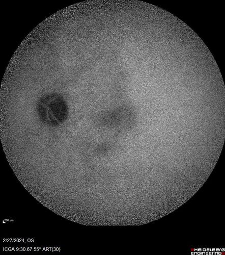 Syphilitic Chorioretinitis
41 year old man with vision loss for five days left eye.  VA 20/32, 20/200
