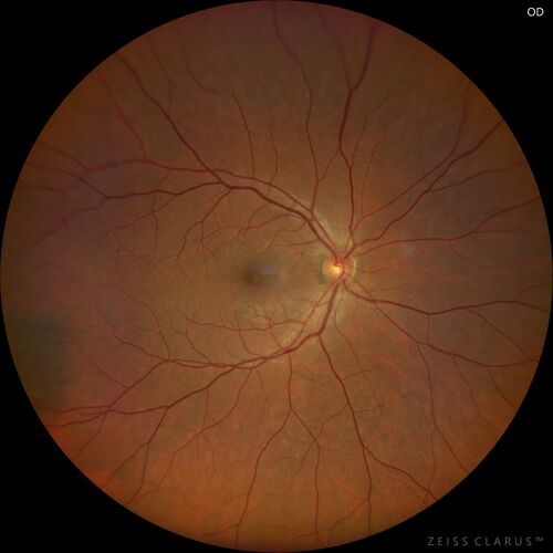 Acute Syphilitic Posterior Placoid Chorioretinitis
40 year old man About 10 days ago the patient woke up with a dark circle in the middle of the left eye that blocks his vision.Â  He thought it might be from fatigue.Â  The month of March was very stressful.Â  After a few days the spot in the left eye got darker and he could not drive at night.Â  During the last week while not going to work and sleeping more his vision is better but not normal.Â  He has never had vision loss in the past.Â Â 
PMHx: Benign,  Meds: Multivitamin
VA OD: sc20/16 NscJ1+VA OS: sc20/32+2 NscJ4
IOP: TP: OD:12 OS:12
