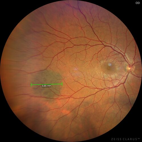 Acute Syphilitic Posterior Placoid Chorioretinitis
40 year old man About 10 days ago the patient woke up with a dark circle in the middle of the left eye that blocks his vision.Â  He thought it might be from fatigue.Â  The month of March was very stressful.Â  After a few days the spot in the left eye got darker and he could not drive at night.Â  During the last week while not going to work and sleeping more his vision is better but not normal.Â  He has never had vision loss in the past.Â Â 
PMHx: Benign,  Meds: Multivitamin
VA OD: sc20/16 NscJ1+VA OS: sc20/32+2 NscJ4
IOP: TP: OD:12 OS:12

