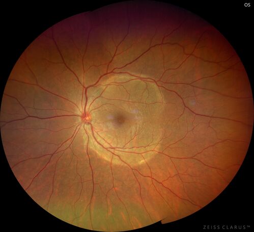 Acute Syphilitic Posterior Placoid Chorioretinitis
40 year old man About 10 days ago the patient woke up with a dark circle in the middle of the left eye that blocks his vision.Â  He thought it might be from fatigue.Â  The month of March was very stressful.Â  After a few days the spot in the left eye got darker and he could not drive at night.Â  During the last week while not going to work and sleeping more his vision is better but not normal.Â  He has never had vision loss in the past.Â Â 
PMHx: Benign,  Meds: Multivitamin
VA OD: sc20/16 NscJ1+VA OS: sc20/32+2 NscJ4
IOP: TP: OD:12 OS:12
