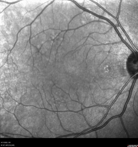 Acute Syphilitic Posterior Placoid Chorioretinitis
40 year old man About 10 days ago the patient woke up with a dark circle in the middle of the left eye that blocks his vision.Â  He thought it might be from fatigue.Â  The month of March was very stressful.Â  After a few days the spot in the left eye got darker and he could not drive at night.Â  During the last week while not going to work and sleeping more his vision is better but not normal.Â  He has never had vision loss in the past.Â Â 
PMHx: Benign,  Meds: Multivitamin
VA OD: sc20/16 NscJ1+VA OS: sc20/32+2 NscJ4
IOP: TP: OD:12 OS:12
