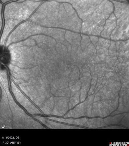 Acute Syphilitic Posterior Placoid Chorioretinitis
40 year old man About 10 days ago the patient woke up with a dark circle in the middle of the left eye that blocks his vision.Â  He thought it might be from fatigue.Â  The month of March was very stressful.Â  After a few days the spot in the left eye got darker and he could not drive at night.Â  During the last week while not going to work and sleeping more his vision is better but not normal.Â  He has never had vision loss in the past.Â Â 
PMHx: Benign,  Meds: Multivitamin
VA OD: sc20/16 NscJ1+VA OS: sc20/32+2 NscJ4
IOP: TP: OD:12 OS:12
