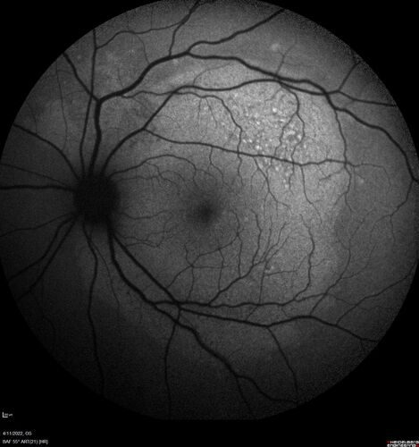 Acute Syphilitic Posterior Placoid Chorioretinitis
40 year old man About 10 days ago the patient woke up with a dark circle in the middle of the left eye that blocks his vision.Â  He thought it might be from fatigue.Â  The month of March was very stressful.Â  After a few days the spot in the left eye got darker and he could not drive at night.Â  During the last week while not going to work and sleeping more his vision is better but not normal.Â  He has never had vision loss in the past.Â Â 
PMHx: Benign,  Meds: Multivitamin
VA OD: sc20/16 NscJ1+VA OS: sc20/32+2 NscJ4
IOP: TP: OD:12 OS:12
