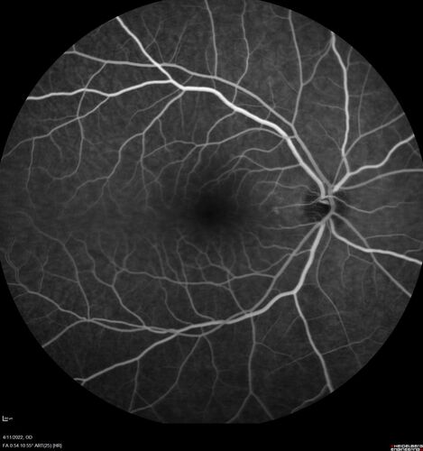 Acute Syphilitic Posterior Placoid Chorioretinitis
40 year old man About 10 days ago the patient woke up with a dark circle in the middle of the left eye that blocks his vision.Â  He thought it might be from fatigue.Â  The month of March was very stressful.Â  After a few days the spot in the left eye got darker and he could not drive at night.Â  During the last week while not going to work and sleeping more his vision is better but not normal.Â  He has never had vision loss in the past.Â Â 
PMHx: Benign,  Meds: Multivitamin
VA OD: sc20/16 NscJ1+VA OS: sc20/32+2 NscJ4
IOP: TP: OD:12 OS:12
